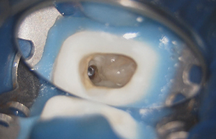 三好歯科自由が丘マイクロスコープでの根管内部の視認性１