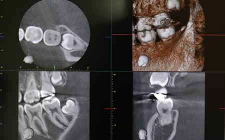 1.CTによる3次元的な骨量・状態などの確認