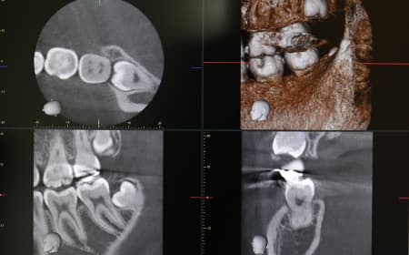 CTスキャンで骨の状態を立体画像で確認