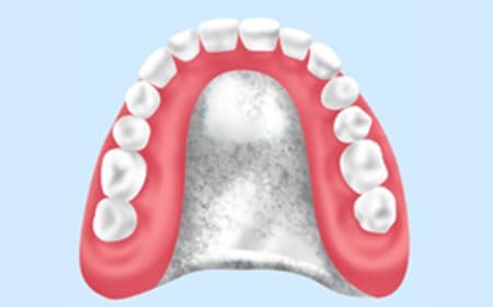 金属床義歯（自費診療）