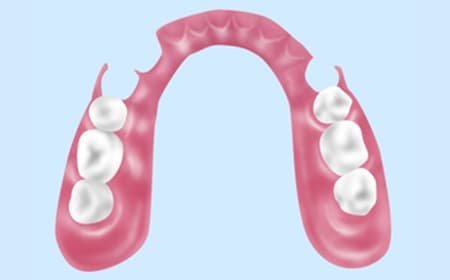 ノンクラスプデンチャー（自費診療）