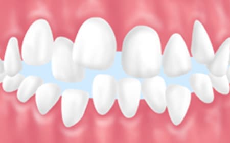 歯並びや噛み合わせの改善も大切です