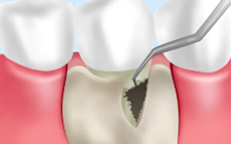 STEP6　歯周外科治療