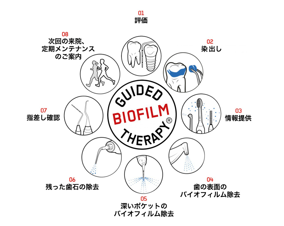 GBT（Guided　Biofilm　Therapy）とは