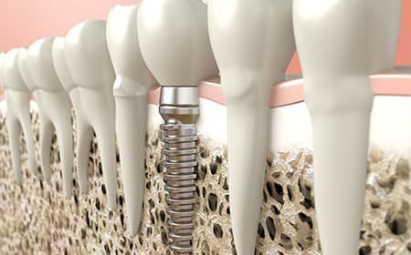 重度の歯周病で失った歯周組織を再生する方法があります