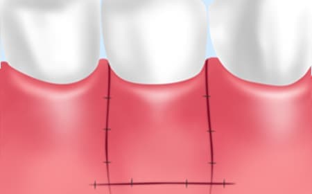 FGG（Free Gingival Graft）