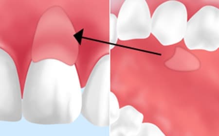 CTG（Connective Tissue Graft）