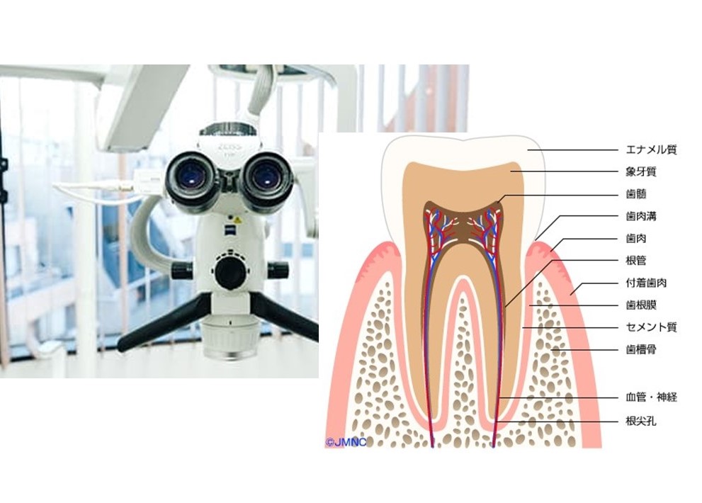 根管治療について｜三好歯科 自由が丘 （院長三好健太郎）