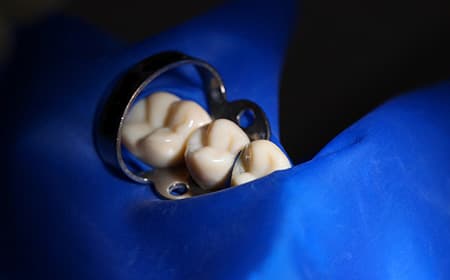三好歯科 自由が丘の根管治療で用いるラバーダムのイメージ