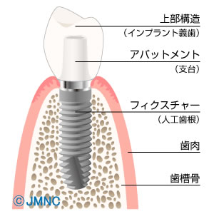 インプラントは歯を失ってしまった場合の１つの選択肢