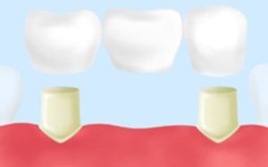 三好歯科 自由が丘のブリッジ（Br）治療のイラスト