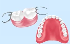 三好歯科 自由が丘の総入れ歯と部分入れ歯のイラスト
