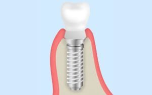 三好歯科 自由が丘のインプラントのイメージイラスト