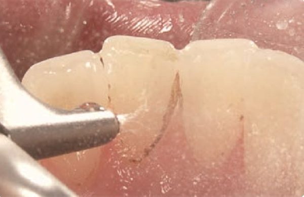 三好歯科 自由が丘で行うエアフローでの歯のクリーニング中の口腔内画像
