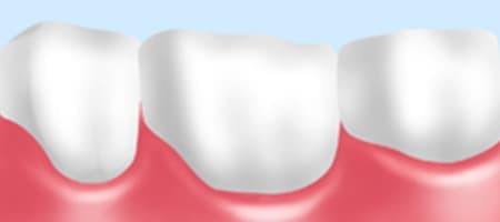 三好歯科 自由が丘 歯の被せ物ジルコニアセラミックの図