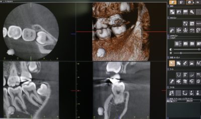 三好歯科 自由が丘の3Dで確認できるCT画像