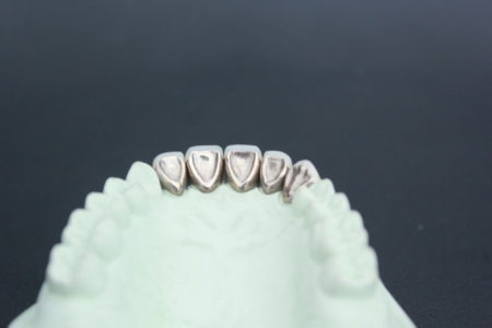 三好歯科自由が丘保険の前歯の白い被せ物の裏側