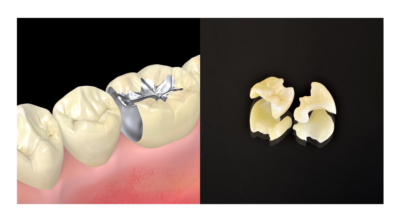 歯の詰め物の素材（マテリアル）とそのメリットデメリット 2021年最新版｜三好歯科 自由が丘｜金属の歯の詰め物とセラミックの歯の詰め物