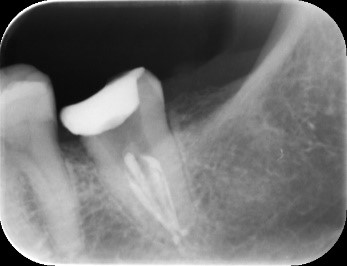 【症例】他院での根管治療で違和感と痛みが消えない歯に対する再根管治療