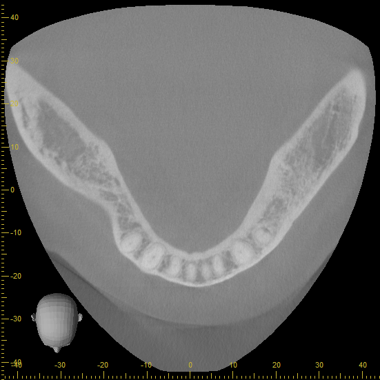【症例】失った歯に対するストローマンガイド・外科用ステントを用いたインプラントオペ