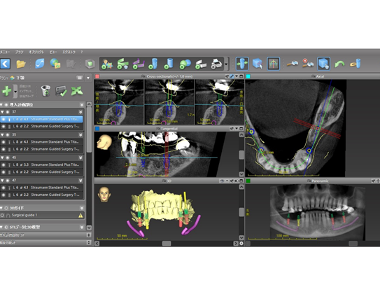 【症例】失った歯に対するストローマンガイド・外科用ステントを用いたインプラントオペ