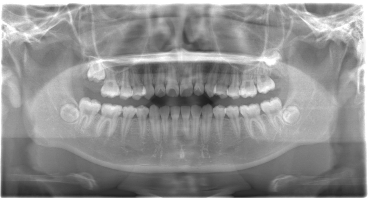 【症例】MTAセメントを用いた直接覆髄法による歯の神経の保存