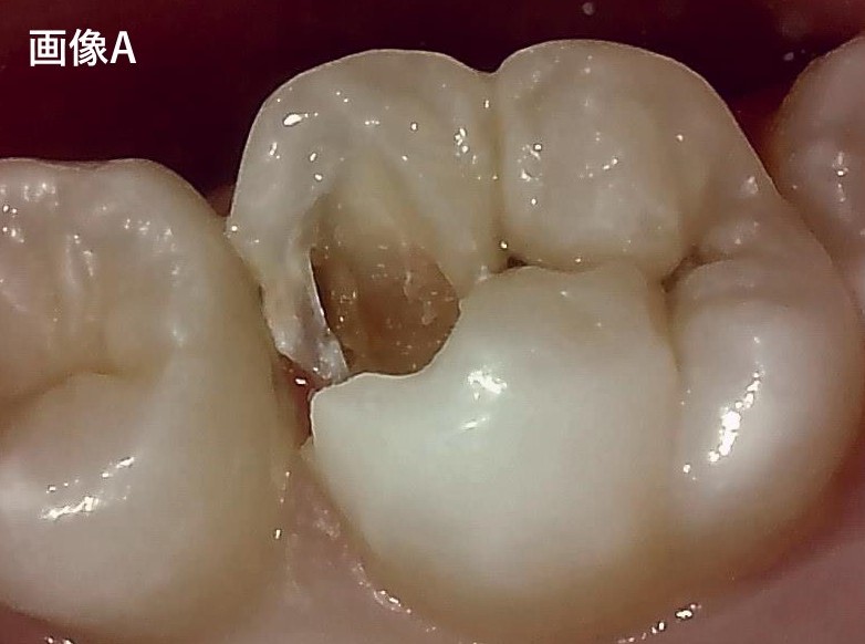 【症例】MTAセメントを用いた直接覆髄法による歯の神経の保存