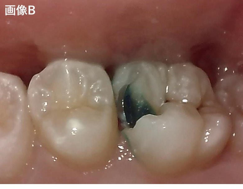 【症例】MTAセメントを用いた直接覆髄法による歯の神経の保存