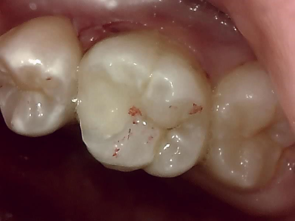 三好歯科 自由が丘 MTG症例0326治療中画像４