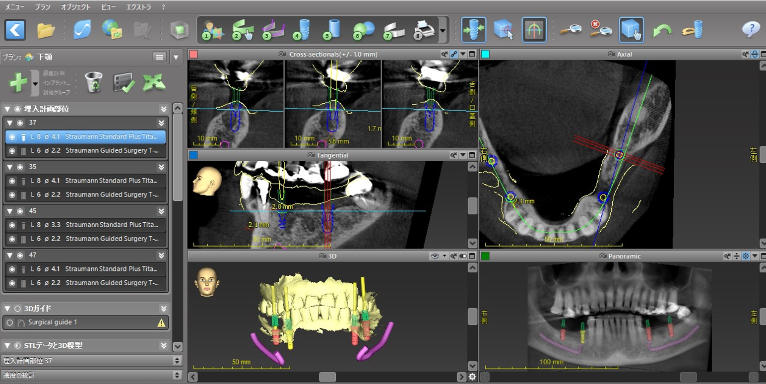 【症例】失った歯に対するストローマンガイド・外科用ステントを用いたインプラントオペ