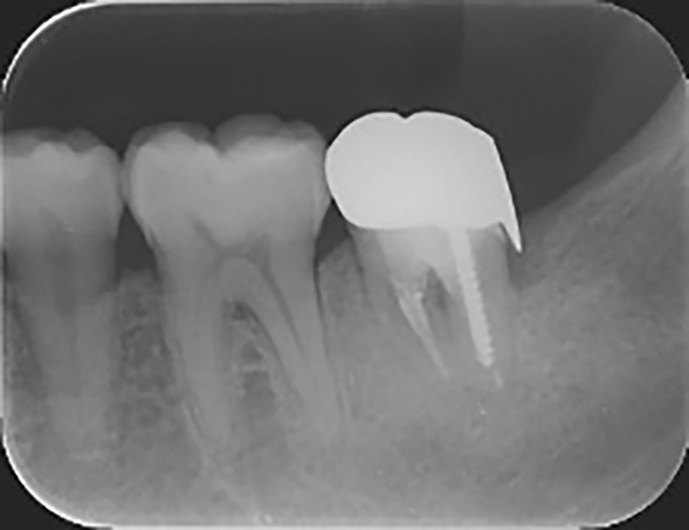 【症例】歯質の少ない歯に対する再根管治療とMTAセメントによる根管充填