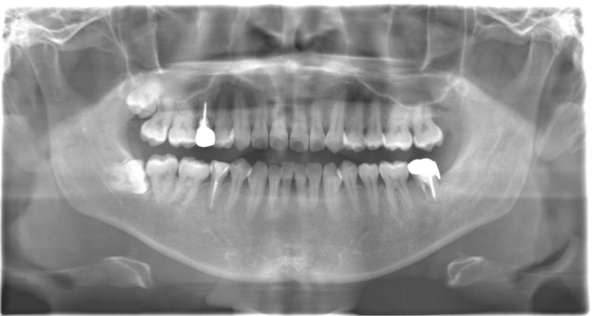 【症例】歯質の少ない歯に対する再根管治療とMTAセメントによる根管充填