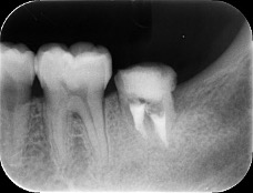 【症例】歯質の少ない歯に対する再根管治療とMTAセメントによる根管充填
