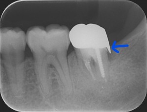 三好歯科 自由が丘 再根管治療症例0619解説画像1