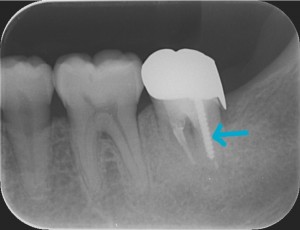 三好歯科 自由が丘 再根管治療症例0619解説画像2