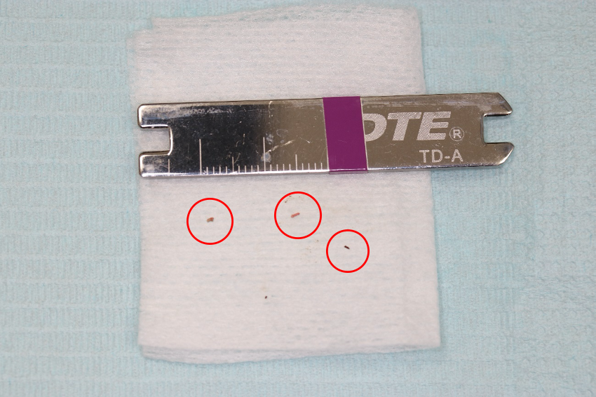 【症例】根管治療の偶発症に対してのリカバリー1　～根尖孔から押し出された異物の除去～