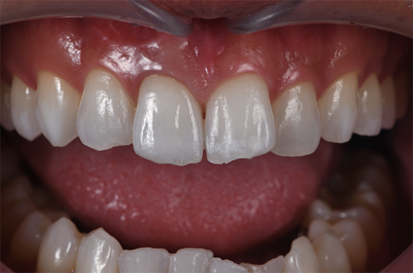 三好歯科 自由が丘_審美歯科の流れとポイント_治療後の口腔内画像