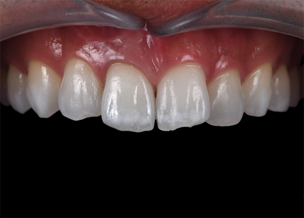 三好歯科 自由が丘_審美歯科の流れとポイント_審美歯科治療後の画像