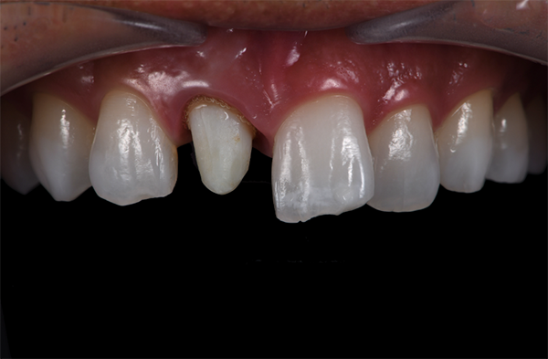 三好歯科 自由が丘_審美歯科の流れとポイント_被せものを入れる前の画像