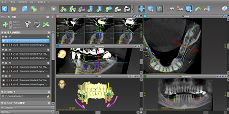 インプラント治療に関する様々なQ＆A｜インプラントのガイデッドサージェリー作成のためのシミュレーション画像｜自由が丘の歯医者 三好歯科自由が丘