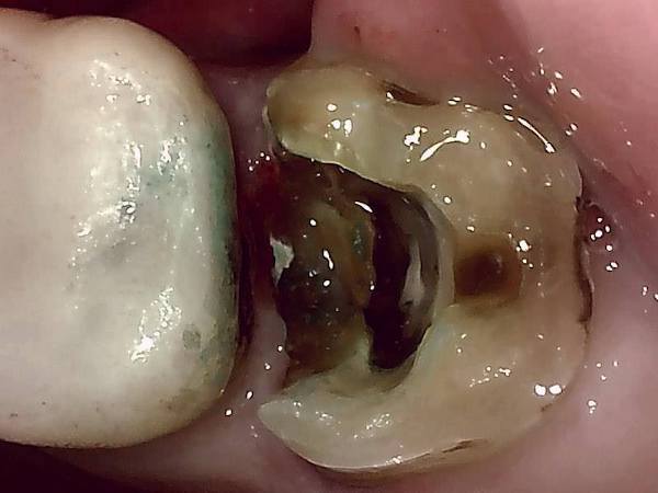 【症例】他院での検診で見落とされた大きなう蝕（虫歯）に対する精密根管治療〜その2〜｜仮封除去後の歯の画像｜自由が丘の歯医者-三好歯科自由が丘