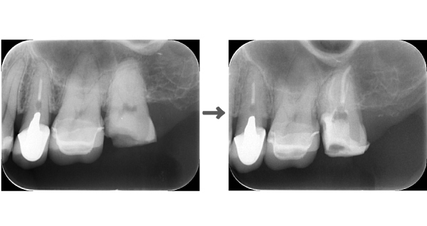 【症例】他院での検診で見落とされた大きなう蝕に対する精密根管治療〜その2〜