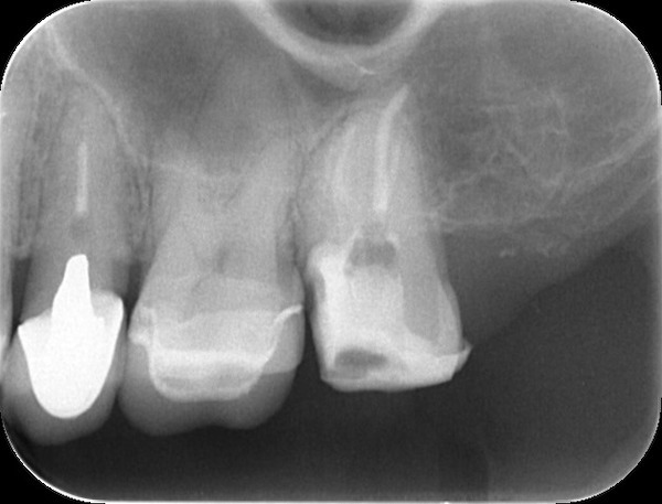 【症例】他院での検診で見落とされた大きなう蝕（虫歯）に対する精密根管治療〜その2〜｜治療後のレントゲン画像｜自由が丘の歯医者-三好歯科自由が丘