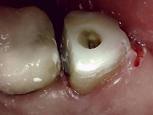 【症例】他院での検診で見落とされた大きなう蝕（虫歯）に対する精密根管治療〜その2〜｜隔壁後の歯の画像｜自由が丘の歯医者-三好歯科自由が丘
