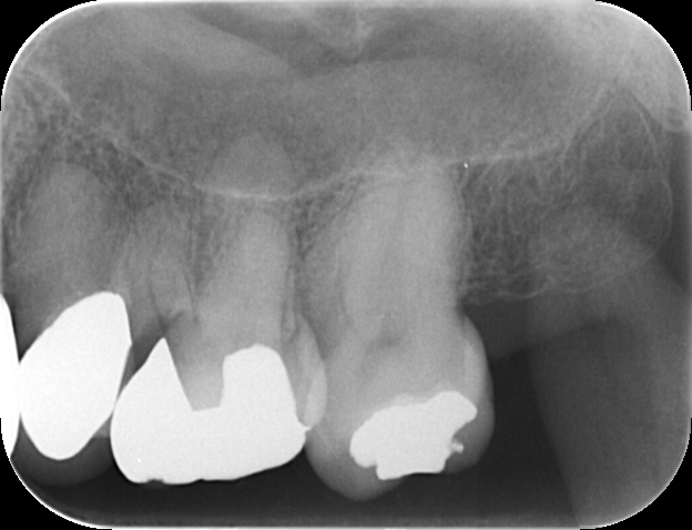 【症例】他院での検診で見落とされた大きなう蝕（虫歯）に対する精密根管治療