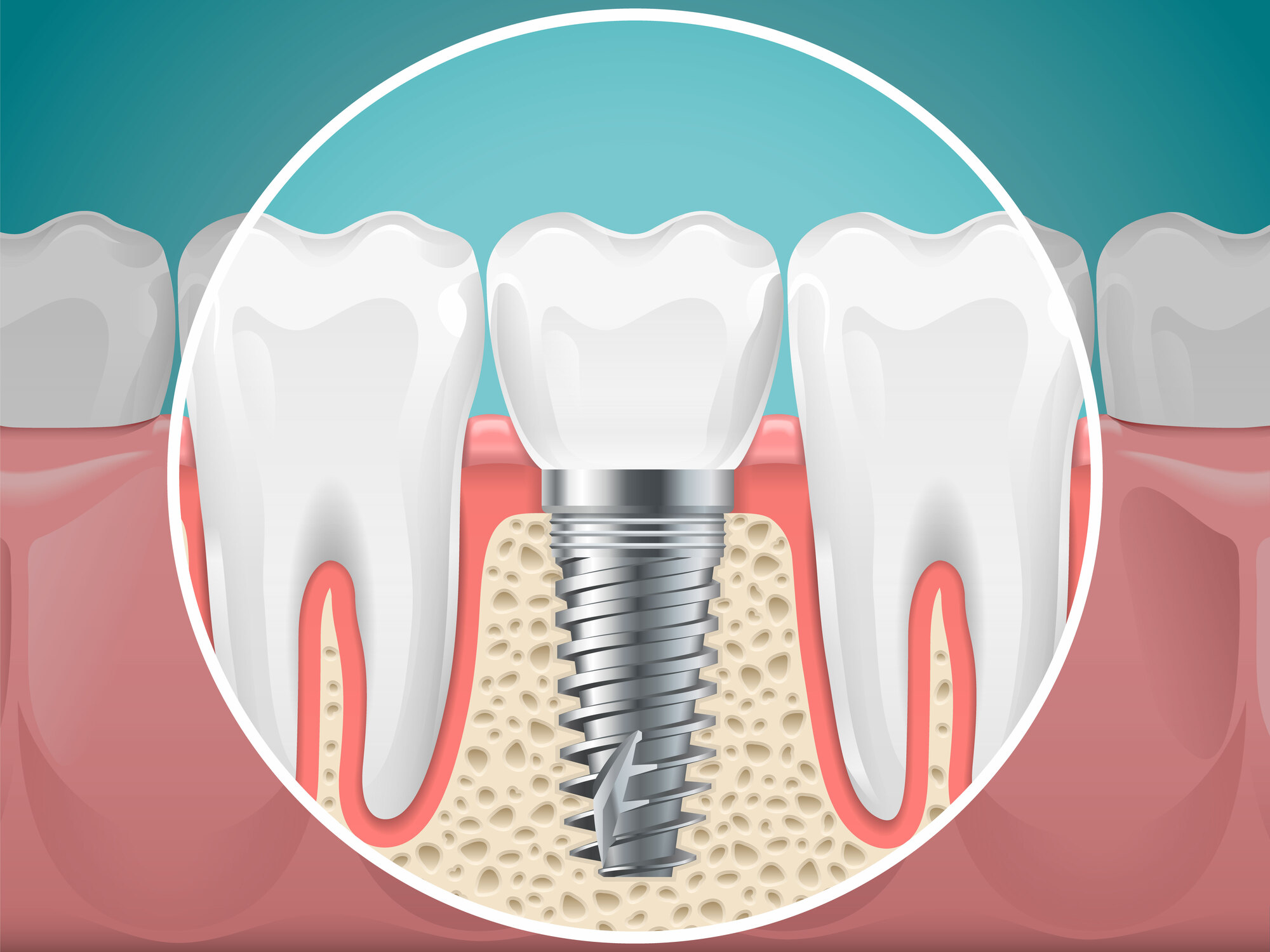 インプラント治療に関する様々なq A 三好歯科 自由が丘 駅徒歩1分 天然歯を残す