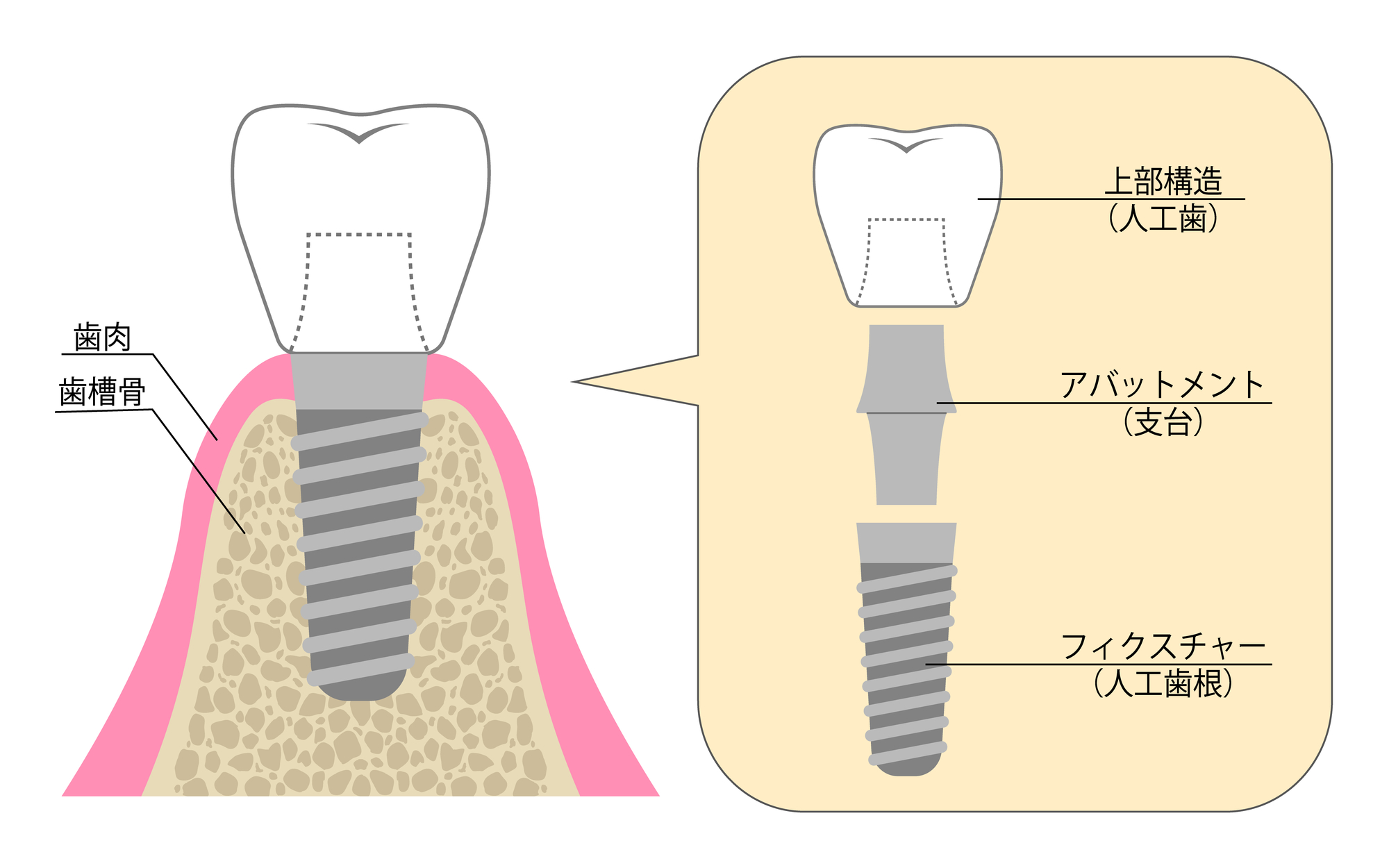 インプラント治療に関する様々なQ＆A｜インプラントの構造のイラスト｜自由が丘の歯医者 三好歯科自由が丘