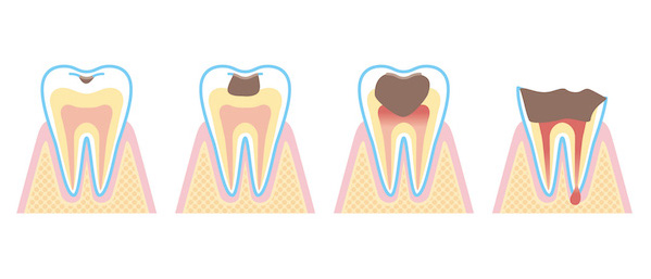 自由が丘の歯医者-三好歯科-自由が丘｜歯科医師コラム｜患者さんの疑問・質問集１＿歯科医院・歯科医師〜治療編〜-虫歯の進行を表すイラスト-1