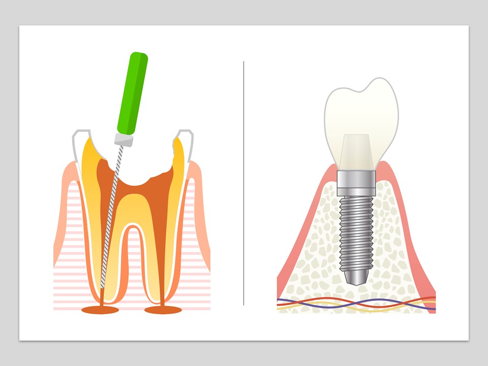 根管治療VSインプラントどちらを選ぶべきか？