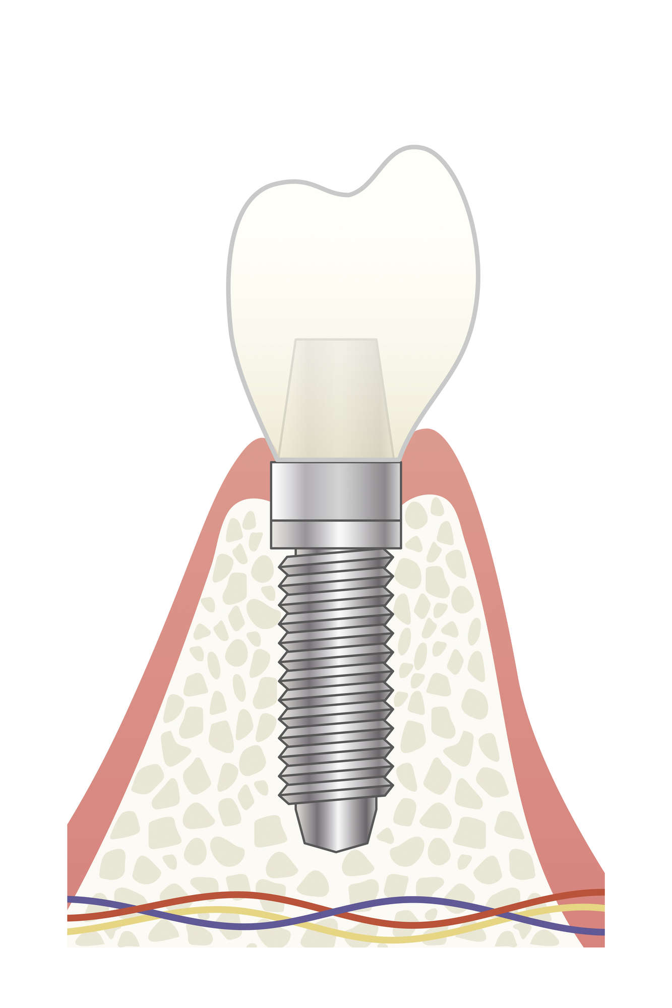 根管治療VSインプラントどちらを選ぶべきか？三好歯科 自由が丘歯科医師コラム、インプラントイメージ